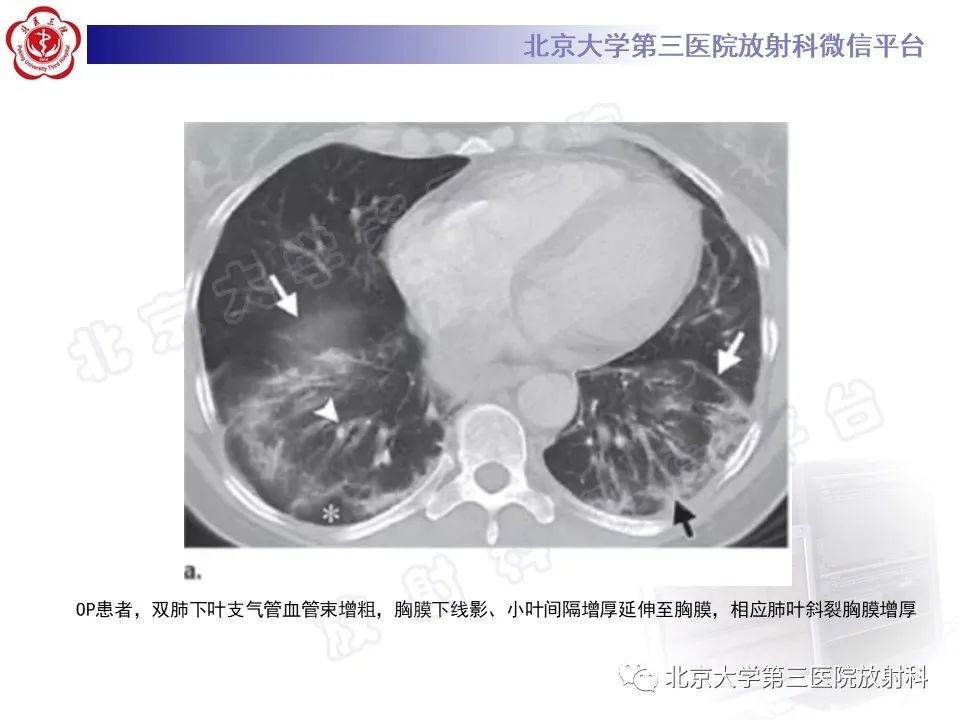 影像PPT - 【PPT】机化性肺炎-28