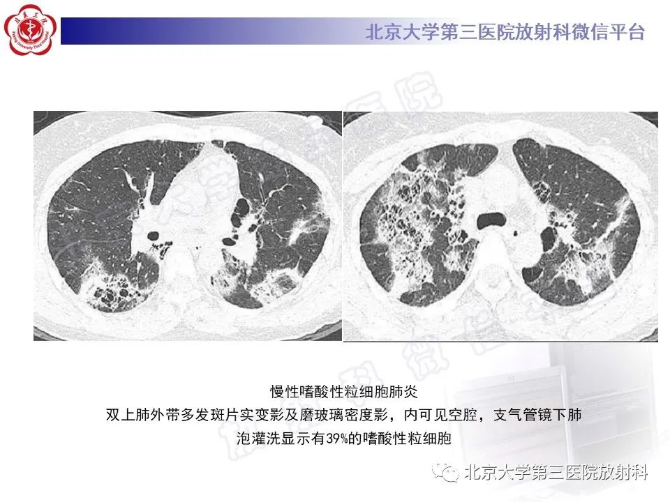 影像PPT - 【PPT】机化性肺炎-31