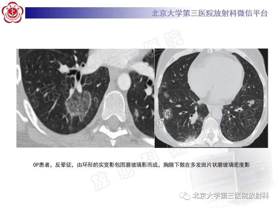 影像PPT - 【PPT】机化性肺炎-23