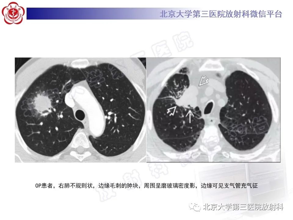 影像PPT - 【PPT】机化性肺炎-21