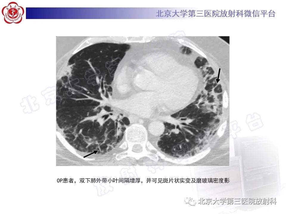 影像PPT - 【PPT】机化性肺炎-25