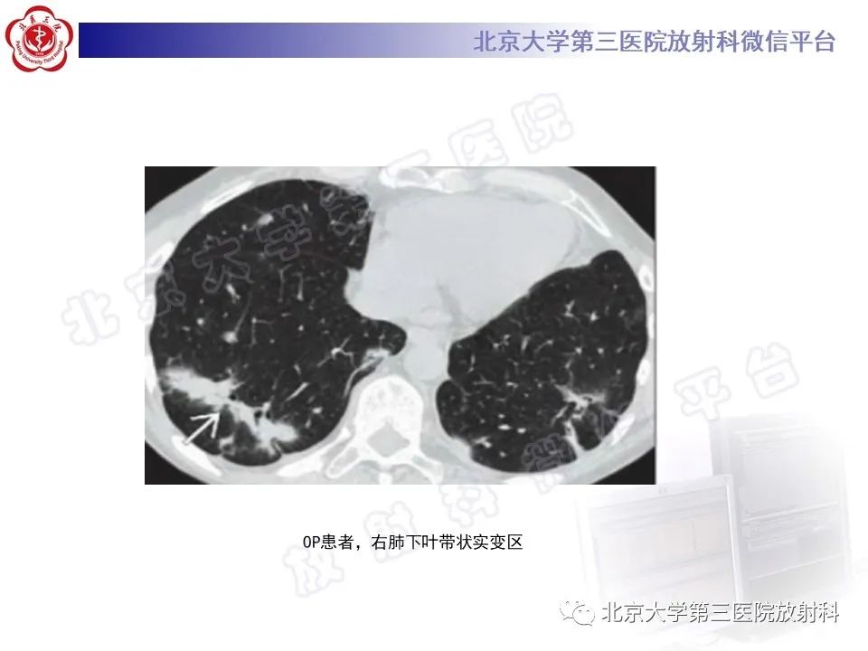 影像PPT - 【PPT】机化性肺炎-19