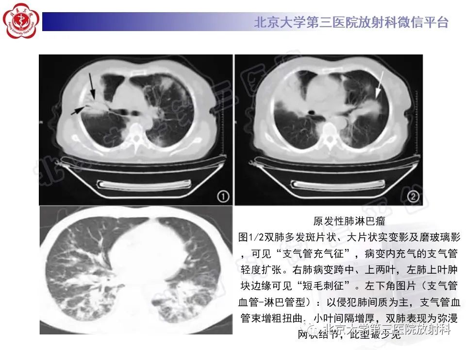 影像PPT - 【PPT】机化性肺炎-34