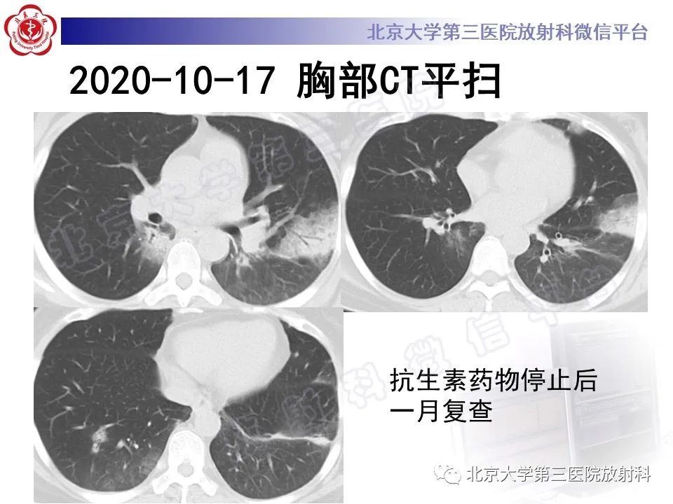 影像PPT - 【PPT】机化性肺炎-6