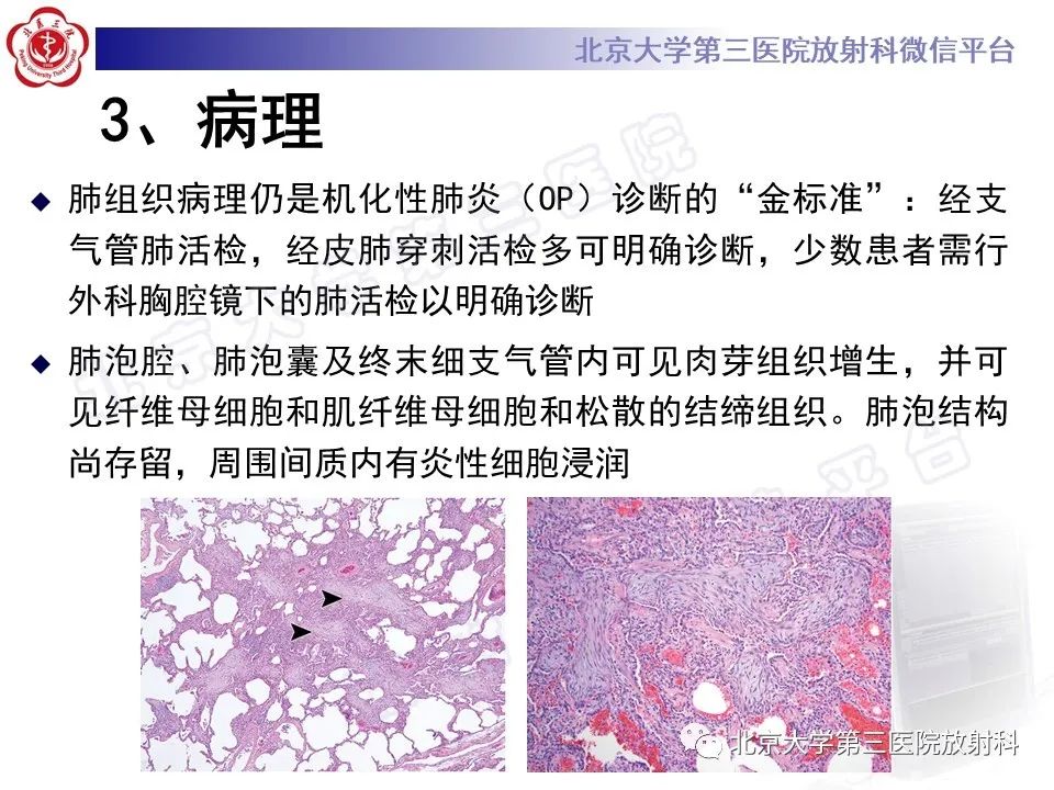 影像PPT - 【PPT】机化性肺炎-14