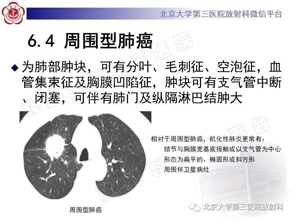 影像PPT - 【PPT】机化性肺炎-36