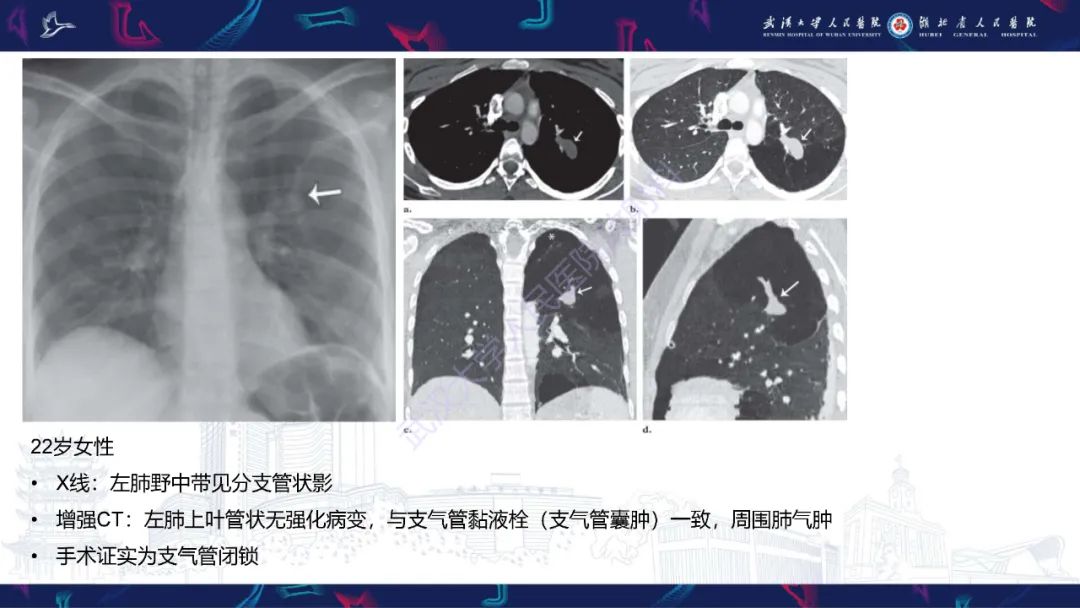 影像PPT - 【PPT】支气管闭锁影像诊断-13