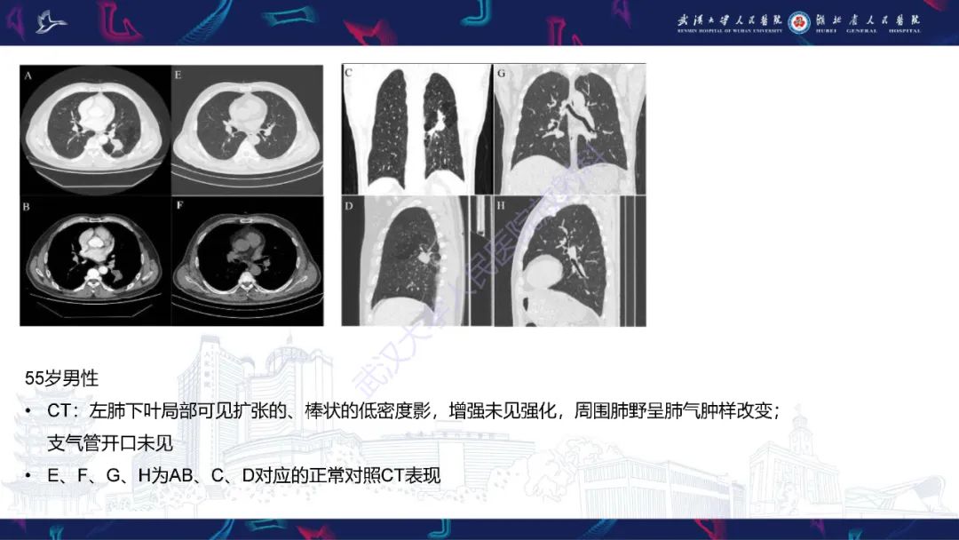 影像PPT - 【PPT】支气管闭锁影像诊断-14