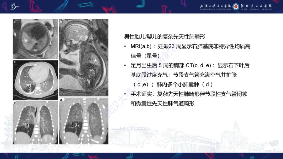 影像PPT - 【PPT】支气管闭锁影像诊断-16