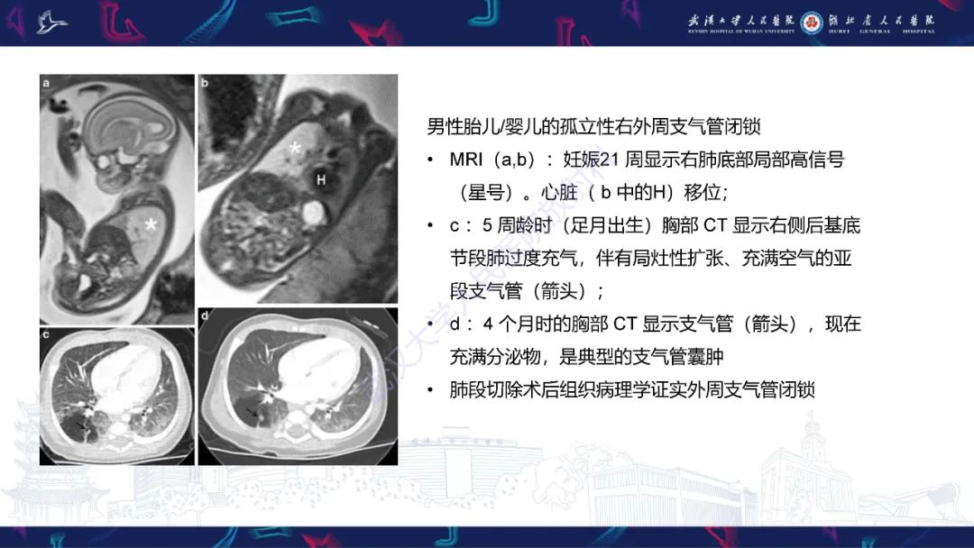 影像PPT - 【PPT】支气管闭锁影像诊断-17