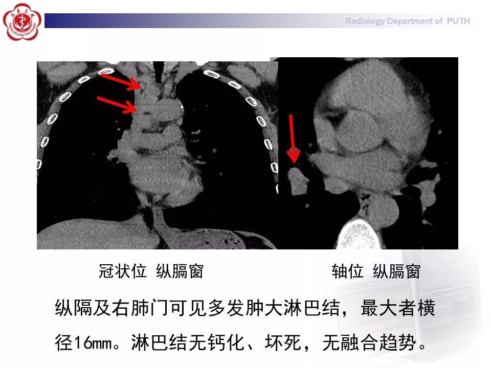 影像PPT - 【PPT】结节病（全身多系统受累）-7