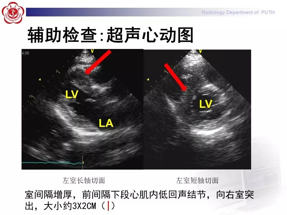 影像PPT - 【PPT】结节病（全身多系统受累）-8