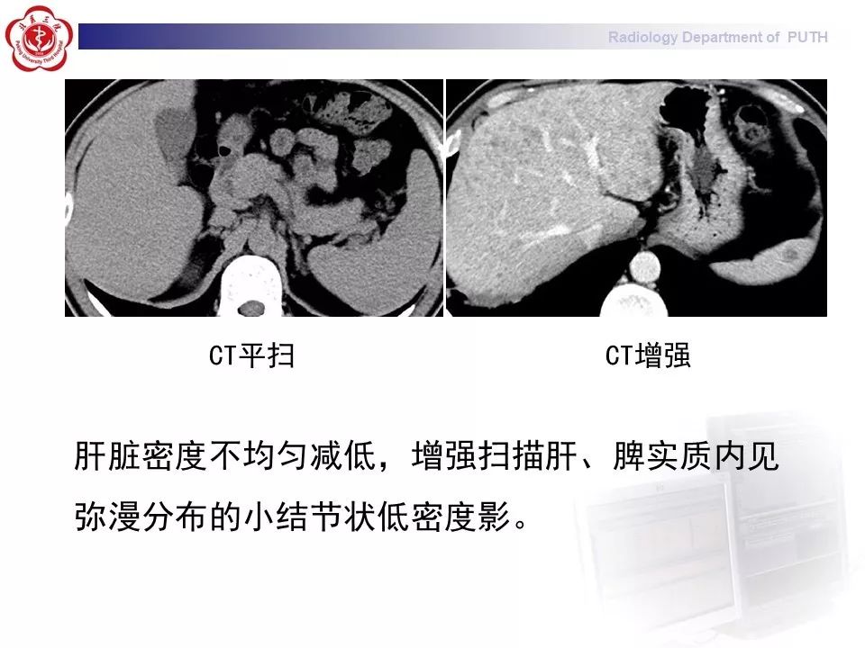 影像PPT - 【PPT】结节病（全身多系统受累）-3