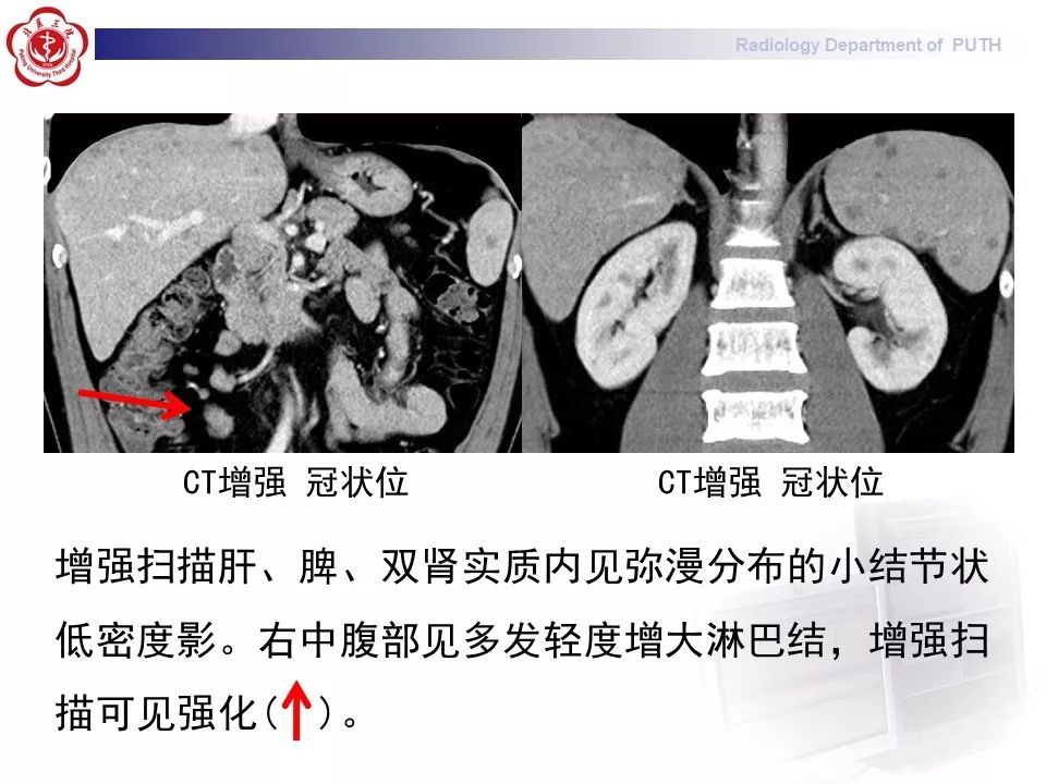 影像PPT - 【PPT】结节病（全身多系统受累）-4