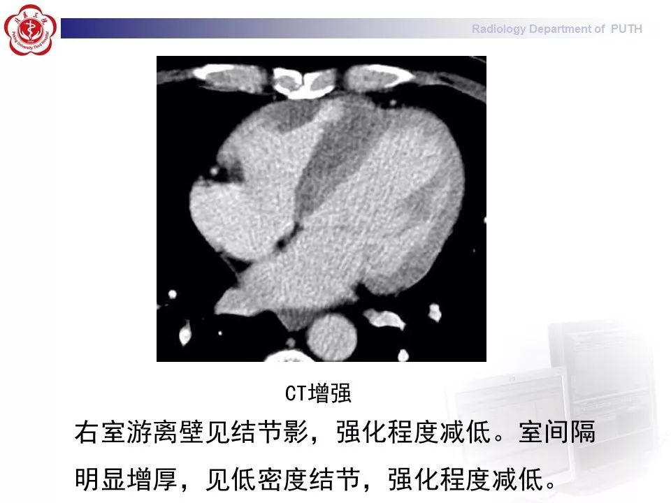 影像PPT - 【PPT】结节病（全身多系统受累）-5