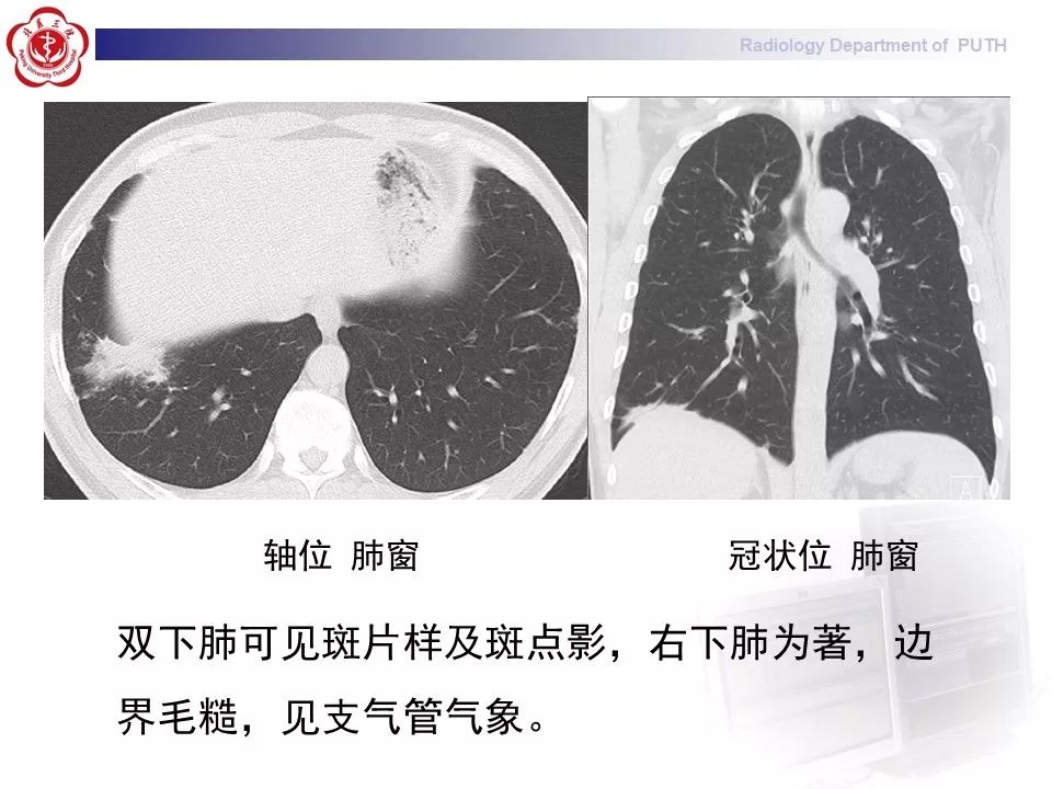 影像PPT - 【PPT】结节病（全身多系统受累）-6