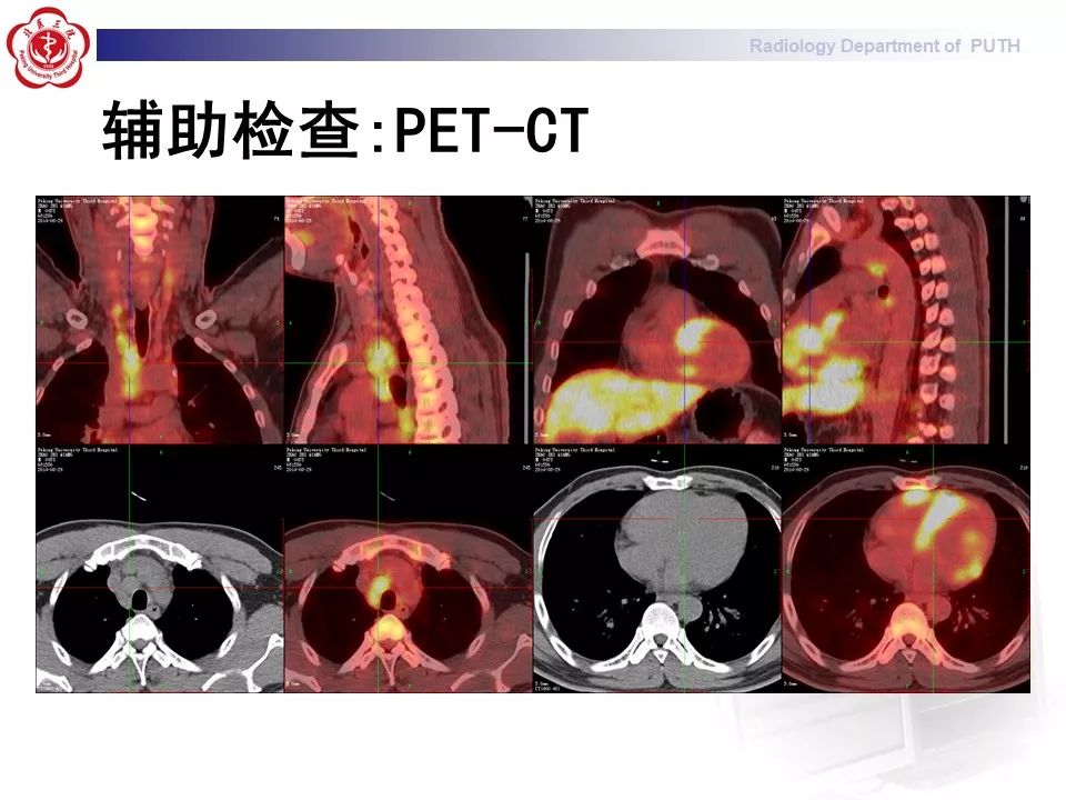 影像PPT - 【PPT】结节病（全身多系统受累）-10