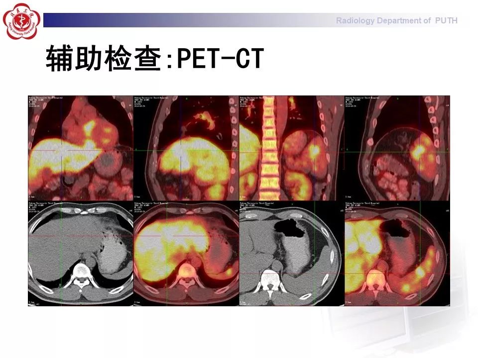 影像PPT - 【PPT】结节病（全身多系统受累）-9