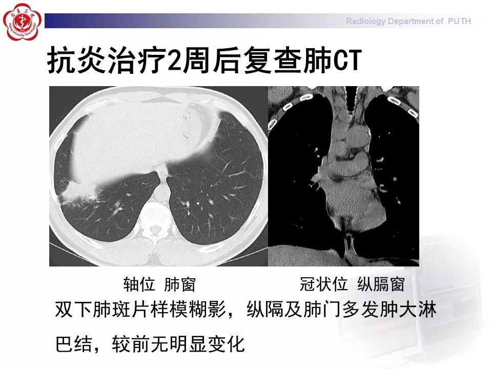 影像PPT - 【PPT】结节病（全身多系统受累）-12