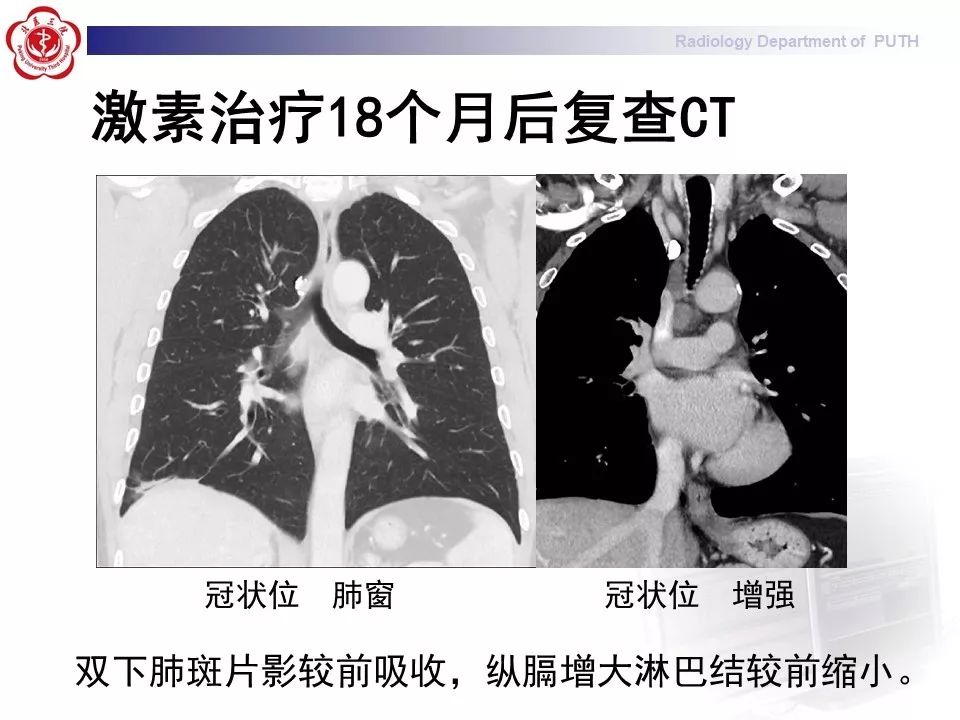 影像PPT - 【PPT】结节病（全身多系统受累）-15