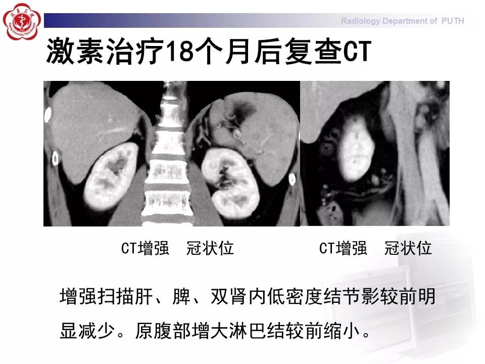 影像PPT - 【PPT】结节病（全身多系统受累）-16