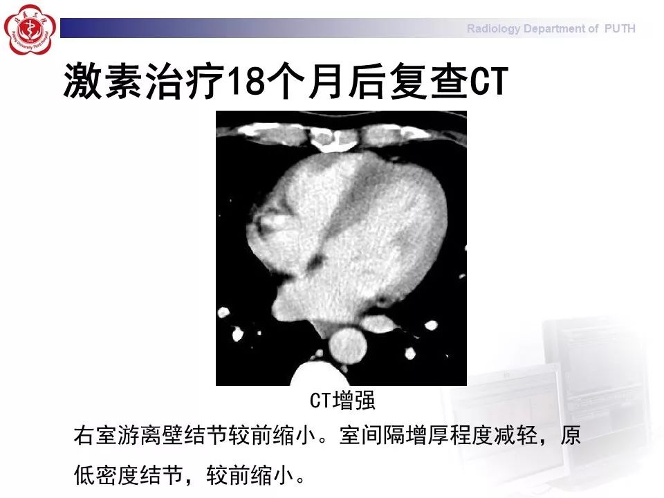 影像PPT - 【PPT】结节病（全身多系统受累）-17