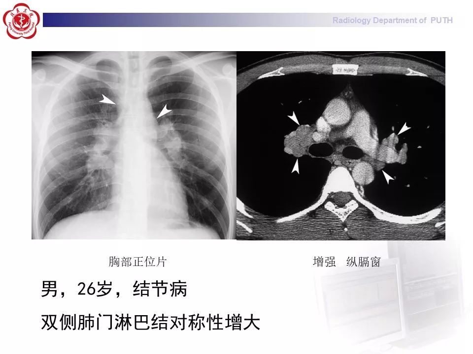 影像PPT - 【PPT】结节病（全身多系统受累）-22
