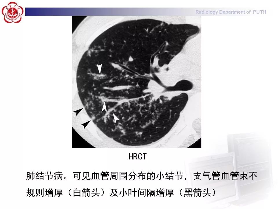影像PPT - 【PPT】结节病（全身多系统受累）-23