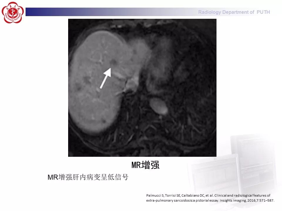 影像PPT - 【PPT】结节病（全身多系统受累）-27