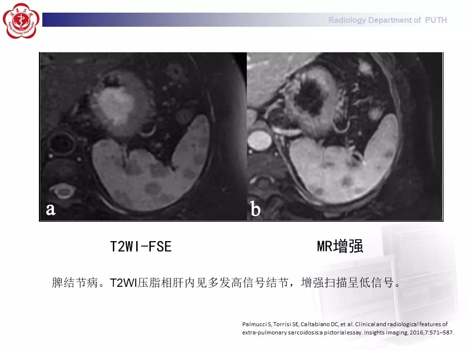 影像PPT - 【PPT】结节病（全身多系统受累）-31