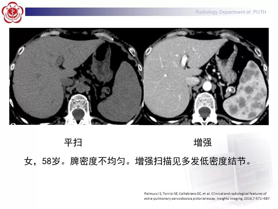 影像PPT - 【PPT】结节病（全身多系统受累）-30