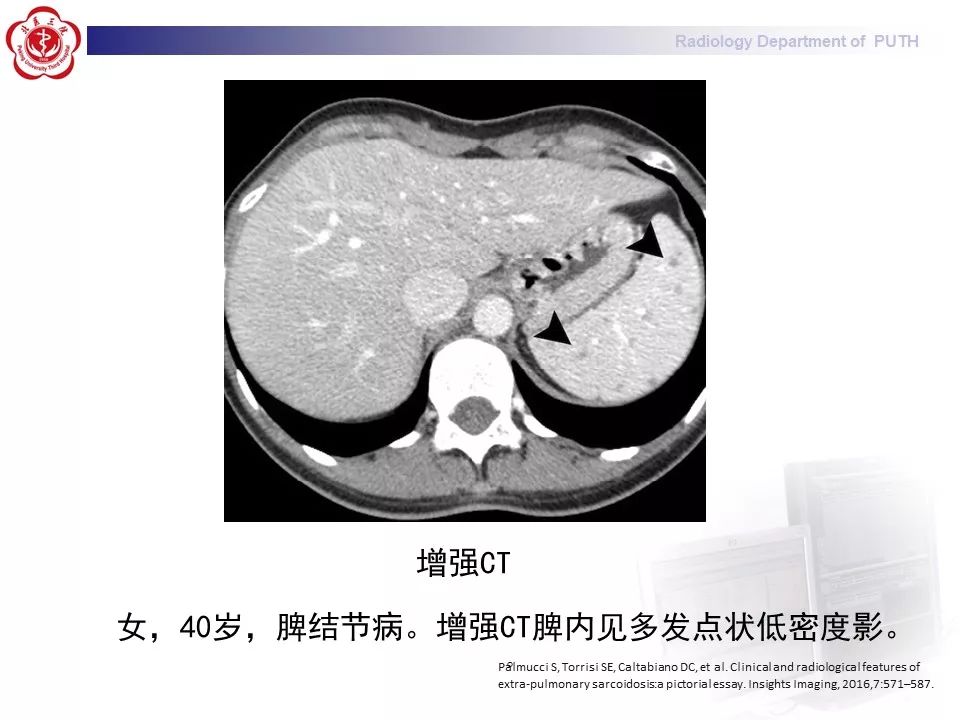 影像PPT - 【PPT】结节病（全身多系统受累）-29