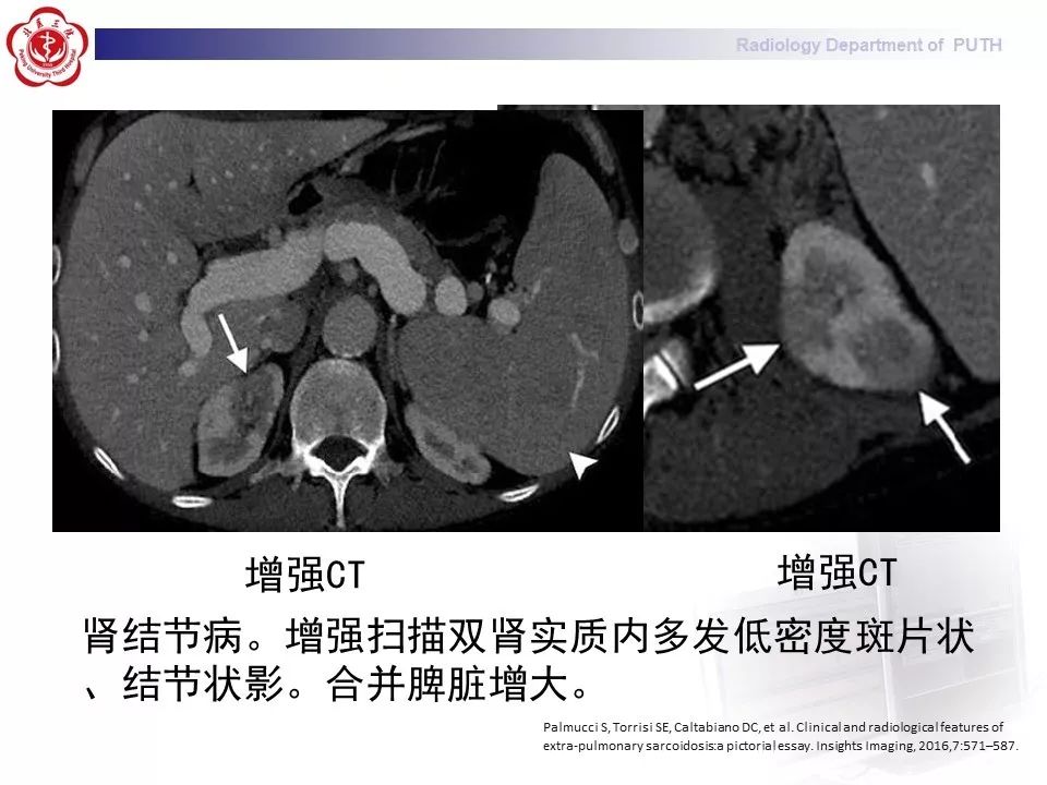 影像PPT - 【PPT】结节病（全身多系统受累）-33