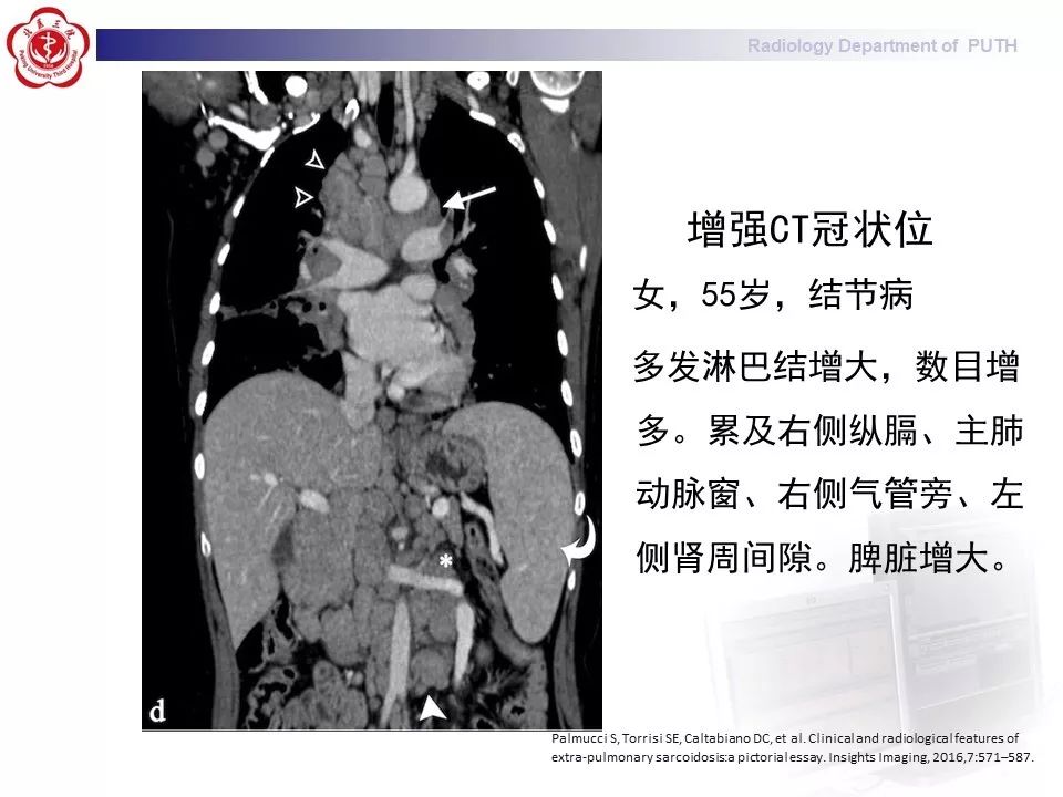 影像PPT - 【PPT】结节病（全身多系统受累）-35