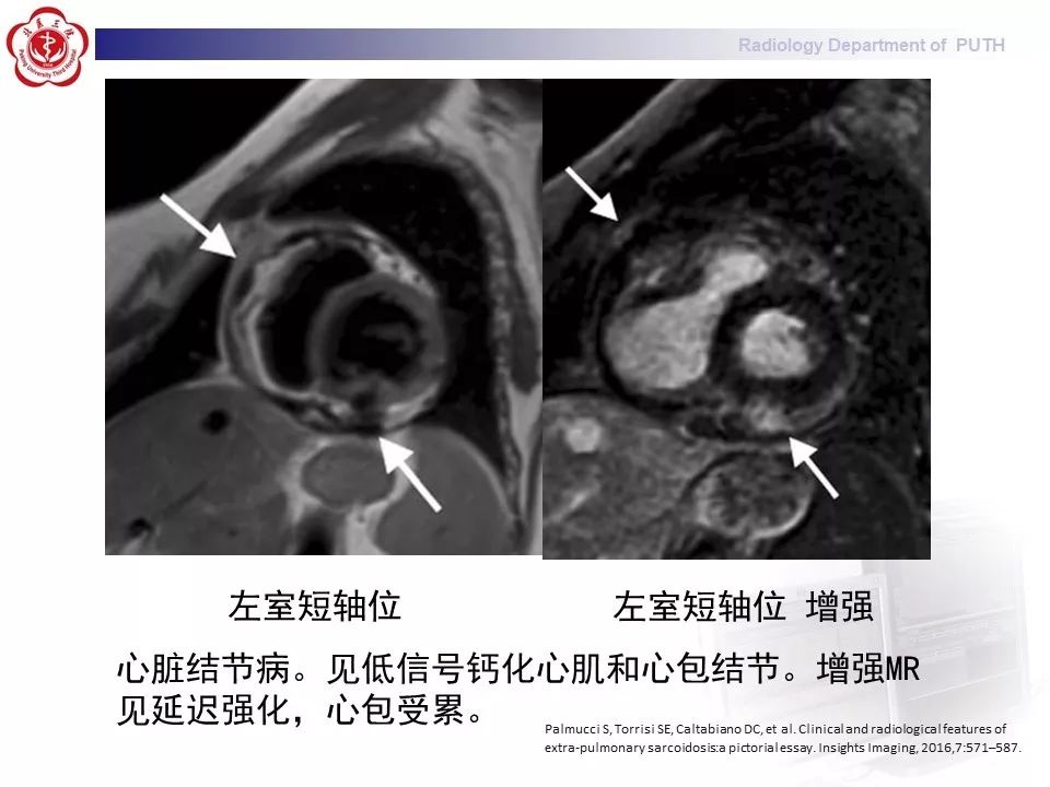 影像PPT - 【PPT】结节病（全身多系统受累）-37