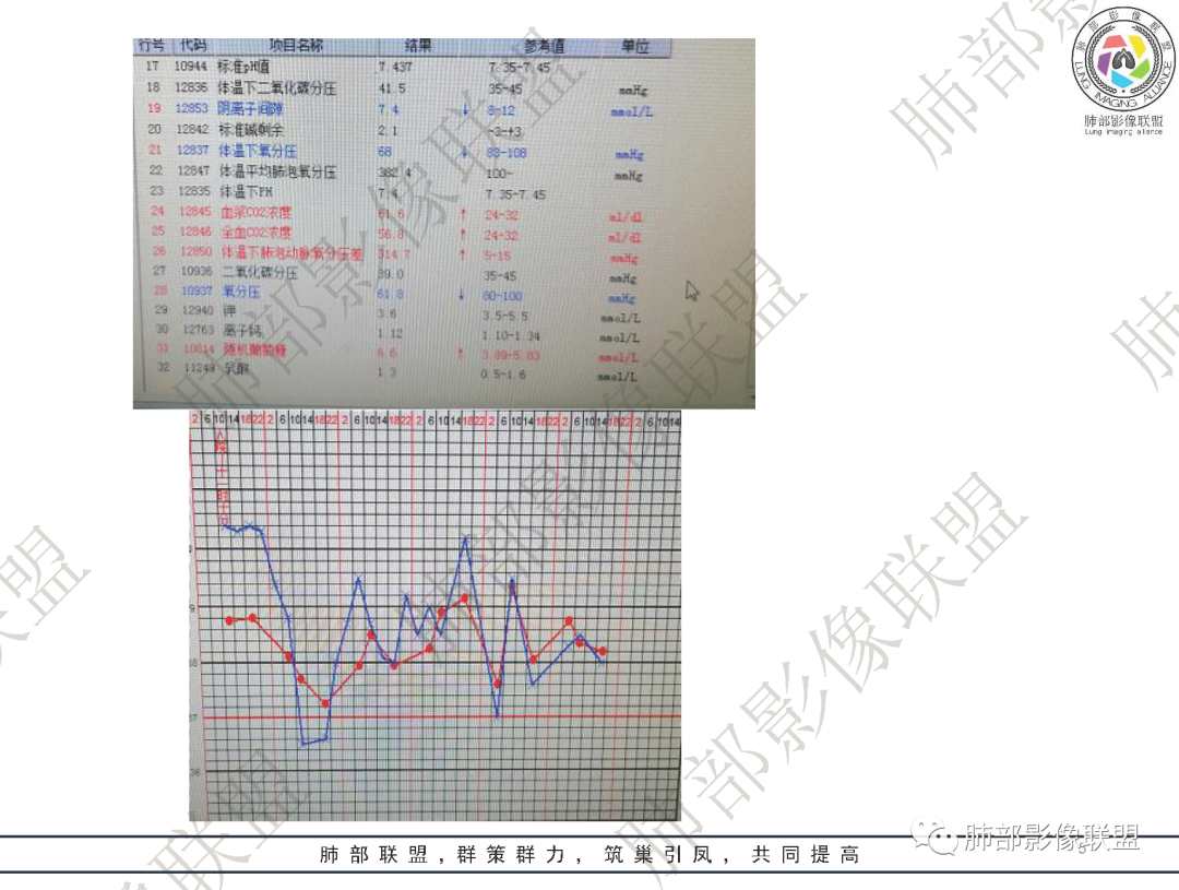 影像PPT - 【病例】鹦鹉热衣原体肺炎1例CT影像-5