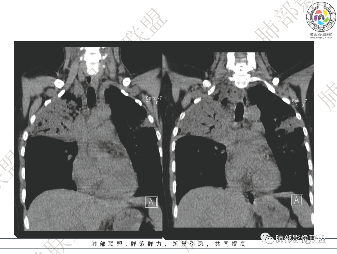 影像PPT - 【病例】鹦鹉热衣原体肺炎1例CT影像-23