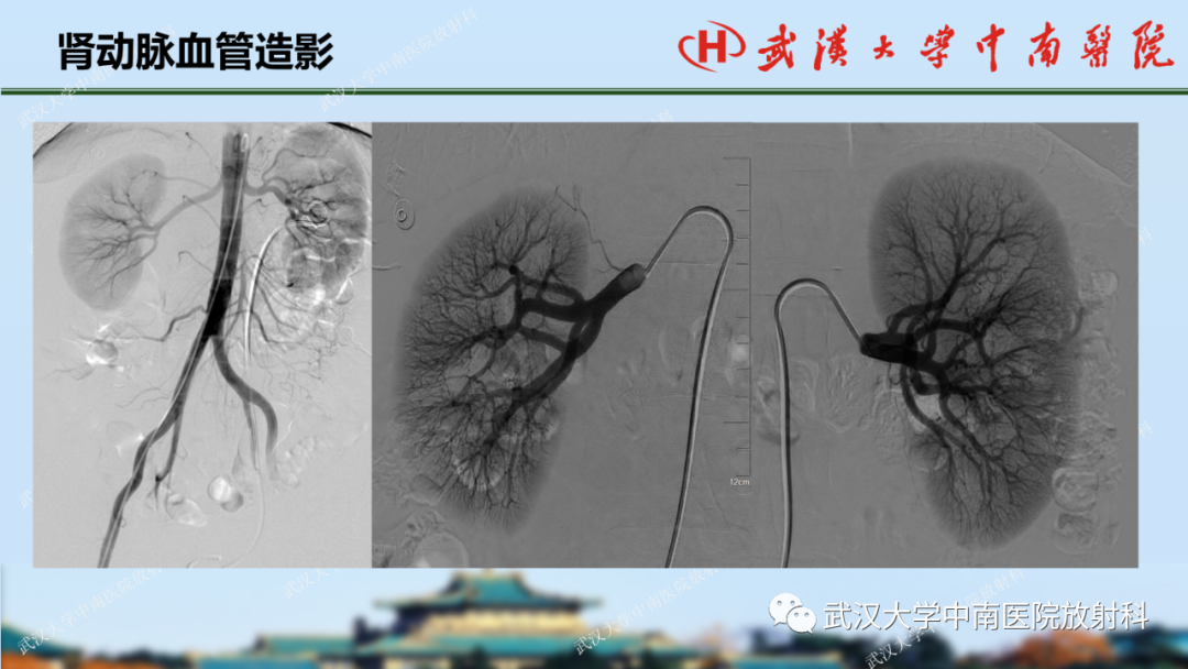 影像PPT - 【PPT】肾脏解剖、实性肾肿瘤-4