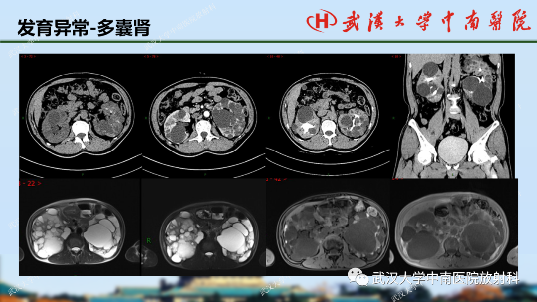 影像PPT - 【PPT】肾脏解剖、实性肾肿瘤-10