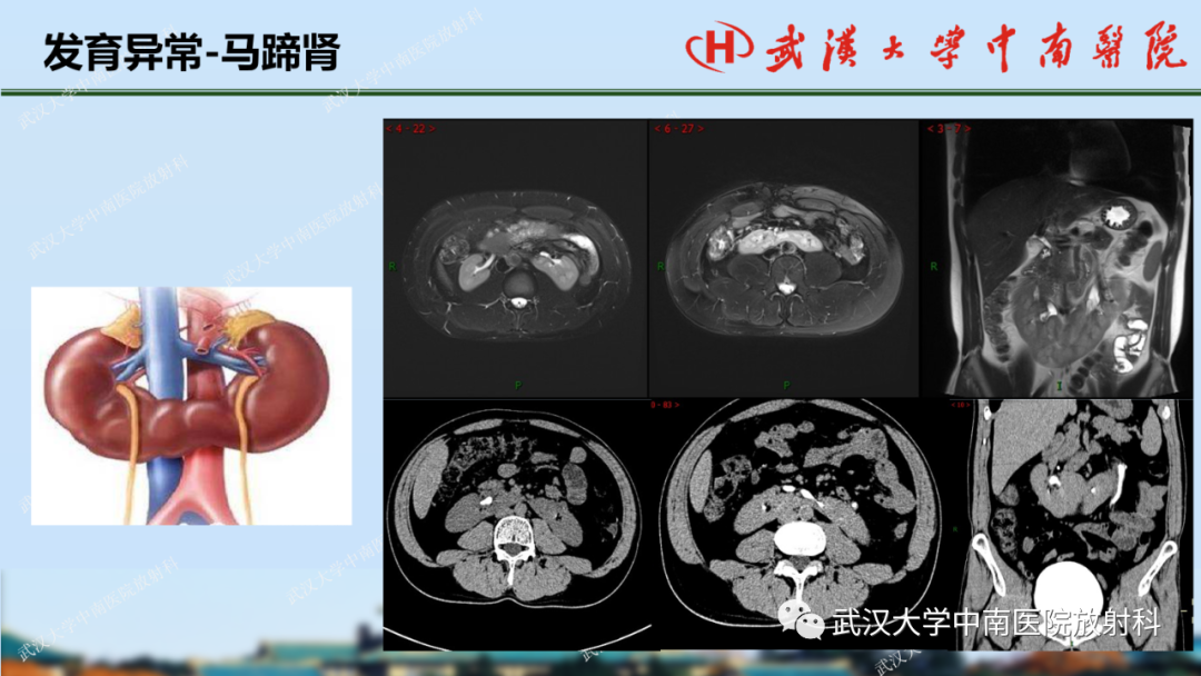 影像PPT - 【PPT】肾脏解剖、实性肾肿瘤-9
