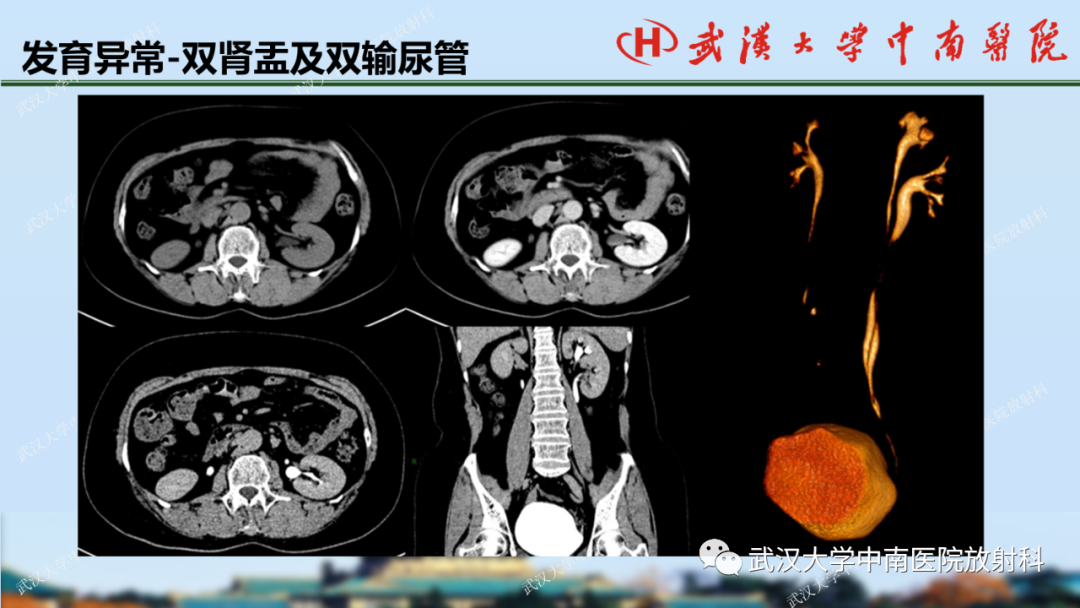 影像PPT - 【PPT】肾脏解剖、实性肾肿瘤-11