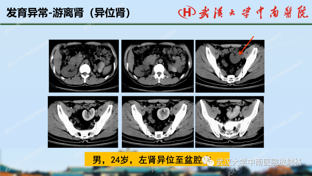 影像PPT - 【PPT】肾脏解剖、实性肾肿瘤-15