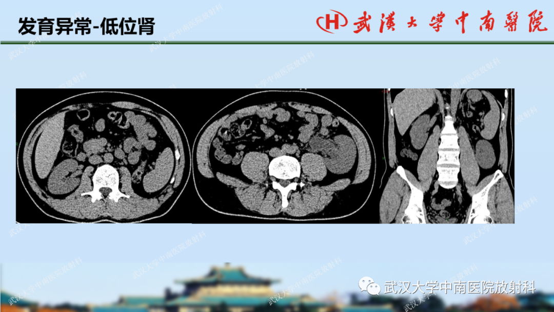 影像PPT - 【PPT】肾脏解剖、实性肾肿瘤-14