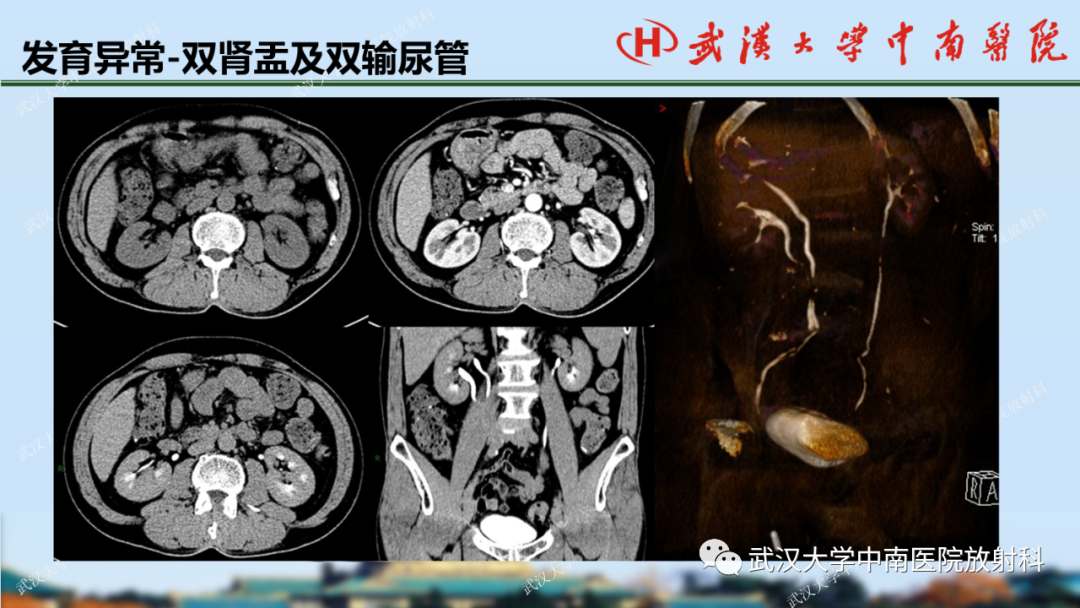 影像PPT - 【PPT】肾脏解剖、实性肾肿瘤-12