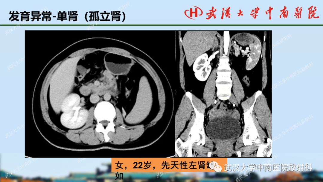 影像PPT - 【PPT】肾脏解剖、实性肾肿瘤-13