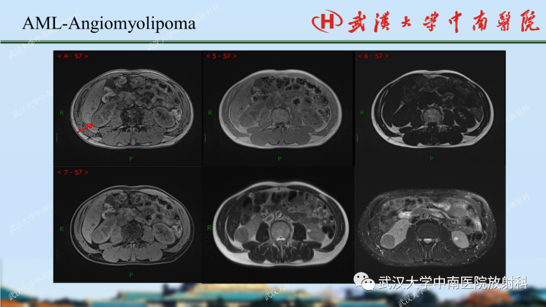 影像PPT - 【PPT】肾脏解剖、实性肾肿瘤-25