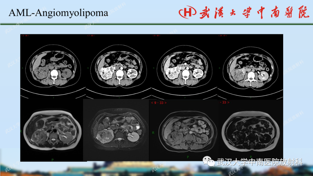 影像PPT - 【PPT】肾脏解剖、实性肾肿瘤-23