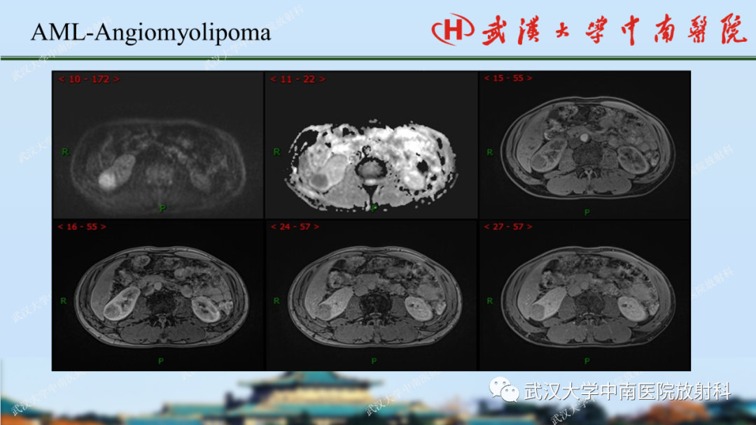 影像PPT - 【PPT】肾脏解剖、实性肾肿瘤-26