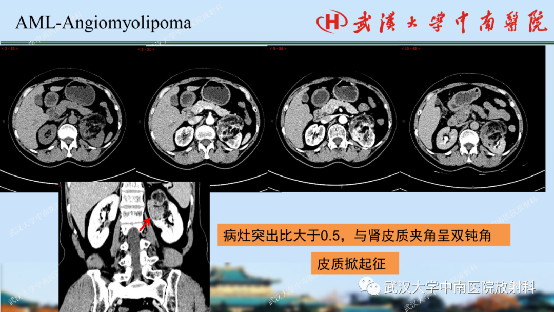 影像PPT - 【PPT】肾脏解剖、实性肾肿瘤-22