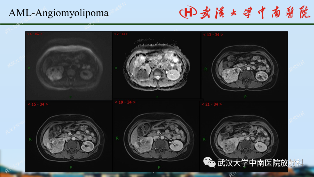 影像PPT - 【PPT】肾脏解剖、实性肾肿瘤-24